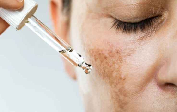 acne-scars